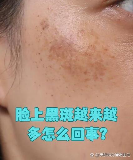 脸上皮肤堵塞排不出黑色素