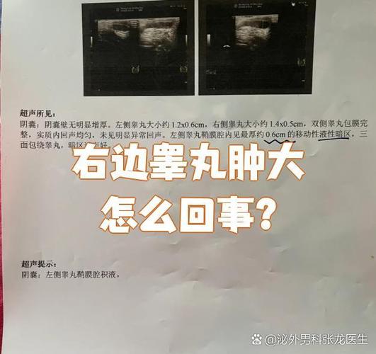 睾丸肿大像鸡蛋一样大是什么病图标