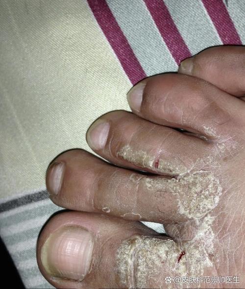 脚藓真菌怎么治才能除根
