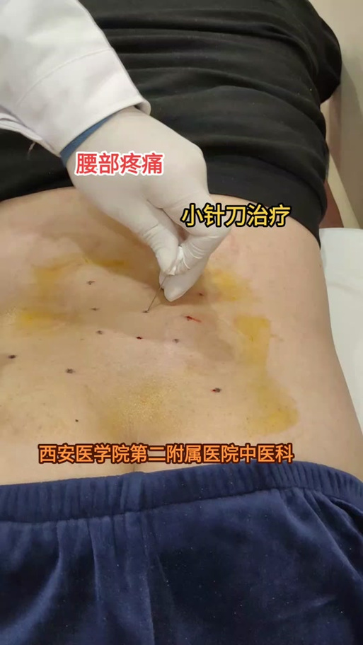 小针刀是什么治疗方法