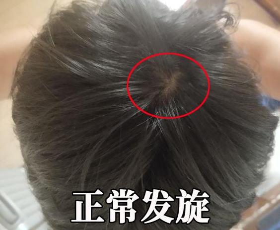 发旋掉头发是什么原因