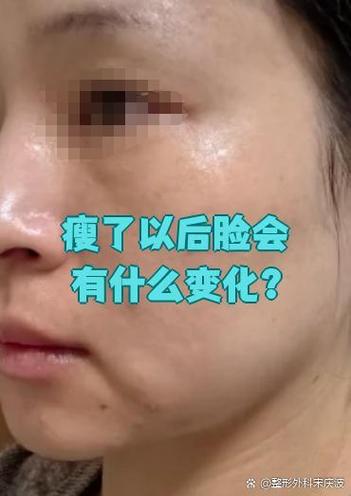 瘦了脸会变小吗