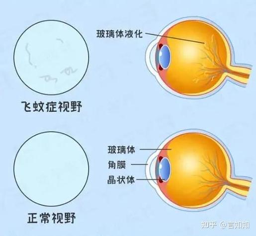 眼睛里的黑影怎么消除