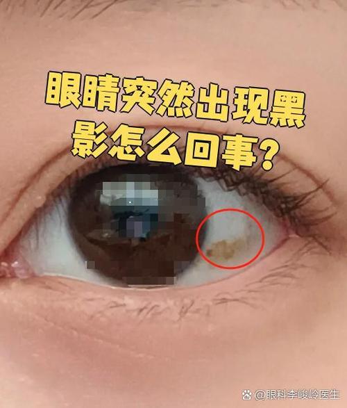 一眨眼有黑影是怎么回事截图