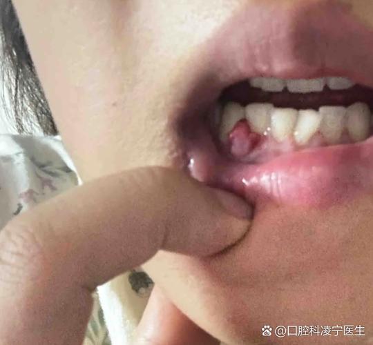 下牙龈内部鼓个包怎么办