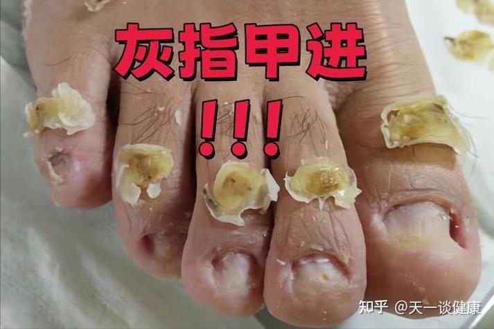 一个去灰指甲的小窍门