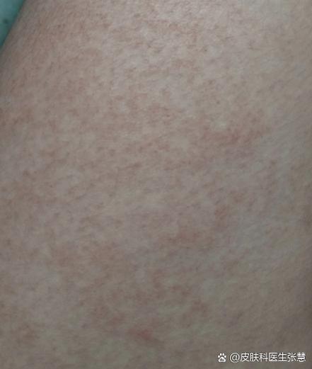 腋下和大腿内侧起红疹