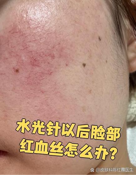 红血丝能做小气泡吗图标