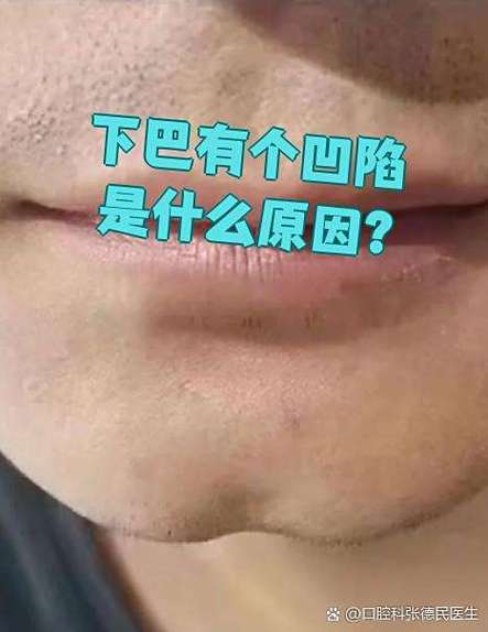 下巴凹陷图片