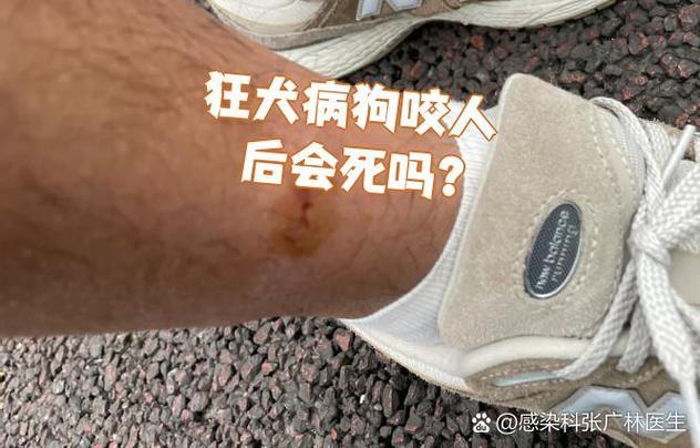 狂犬狗咬人之后是不是会死截图