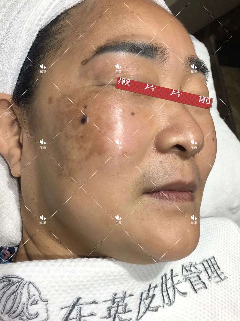 X后摄像头出现黑点