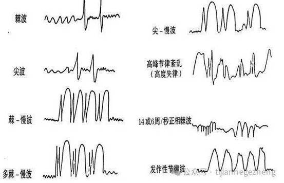多量棘波是不是严重