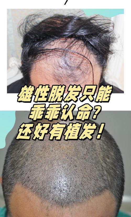 秃顶有什么办法恢复正常截图