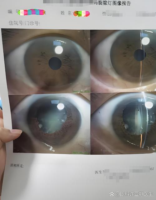 看东西老是重影是怎么回事