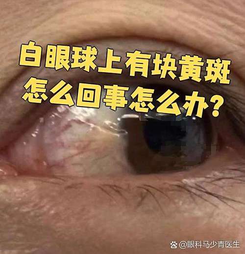眼白有黄斑