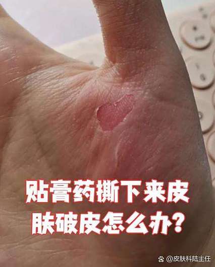 贴膏药撕掉后遗留的胶截图