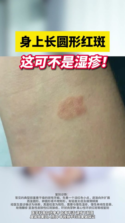 脸上一块红红的像癣怎么办