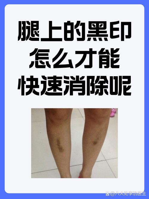 黑色签字笔怎么消除字迹