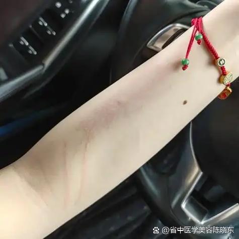 身上划痕是艾滋病初期症状吗