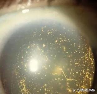 飞蚊症做什么检查能查出来