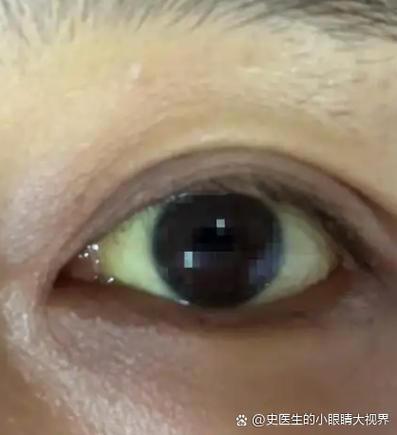 眼球发黄一定是肝病吗图标