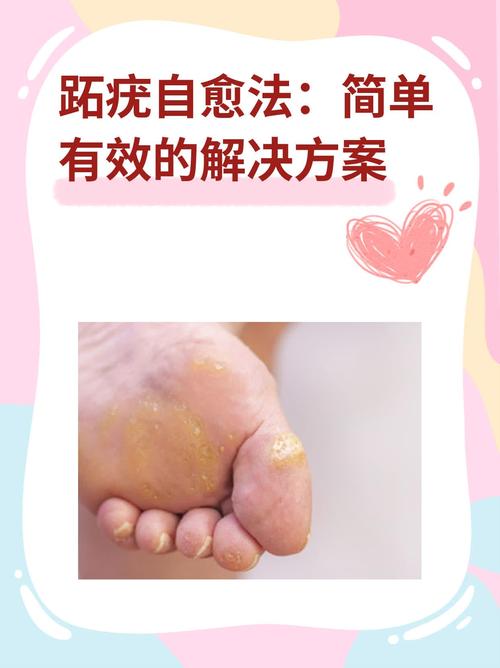 跖疣专用药膏图标