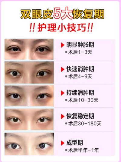 埋线为什么不建议做
