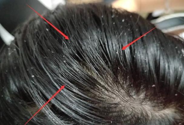 头皮出油视频