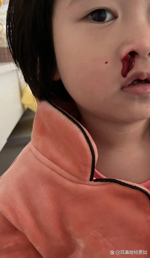 鼻子老流鼻血缩略图