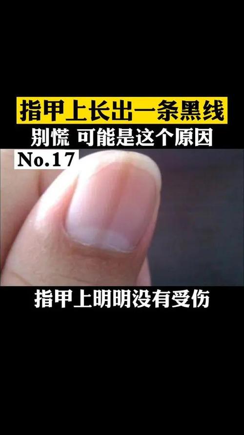 指甲一条黑线怎么回事