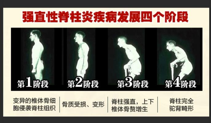 强直治疗费用大概多少