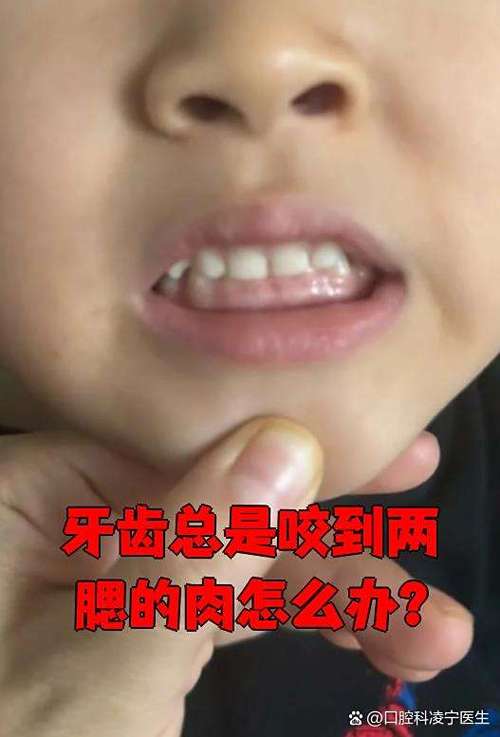 咬破腮帮子怎么处理