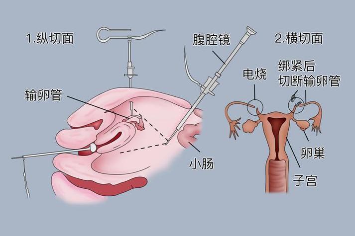 宫腹腔镜手术通输卵管成功率高吗
