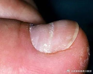 博氏线是大病吗