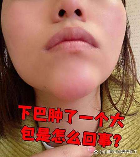 下巴无缘无故肿了硬包