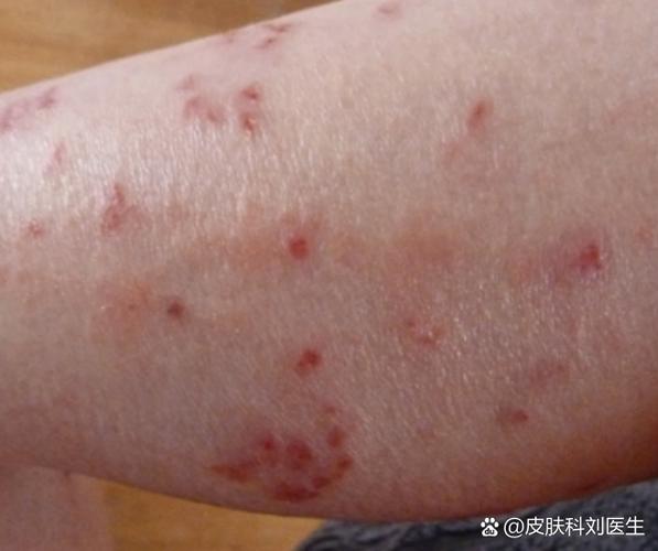 身上突然起了好多红疙瘩特别痒