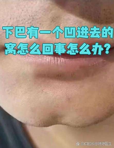 下巴有个凹陷怎么修复