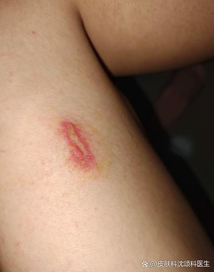 男生大腿内侧出现红紫疤痕图片截图