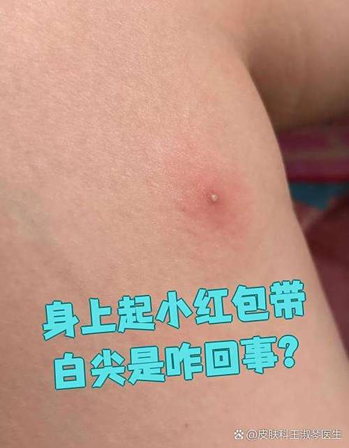 身上起个红包上面带白色皮