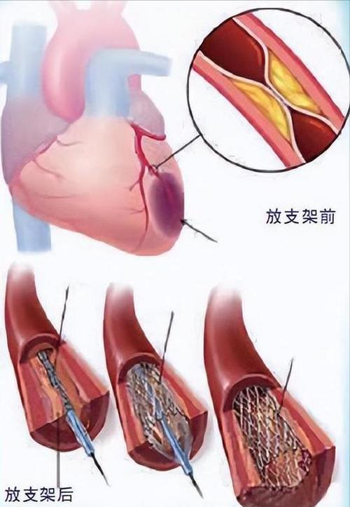 心脏血管放支架能撑多少年