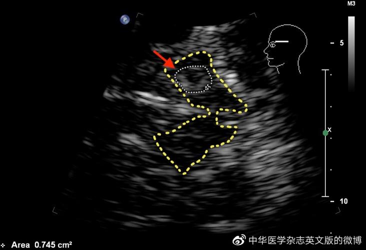 脑黑质回声三级代表了什么