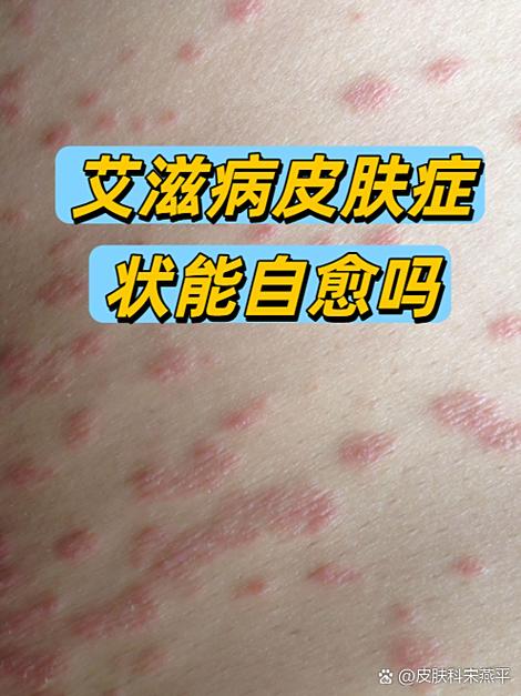 一身艾滋病症状查不到抗体