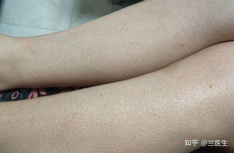 身上的鸡皮疙瘩怎样才能弄掉截图