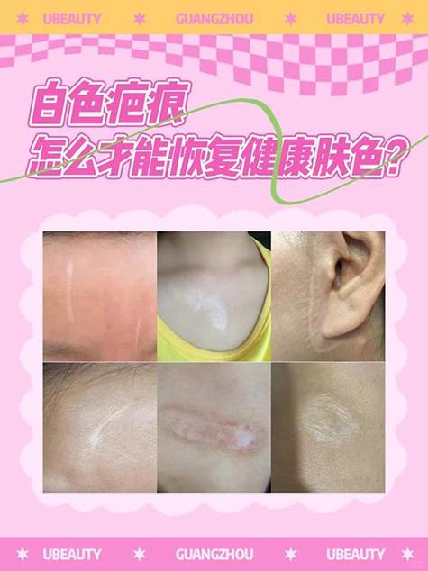 白色疤痕是恢复好了吗