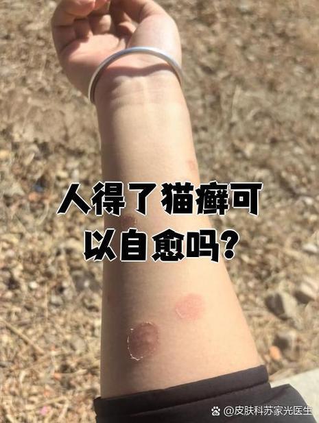 人得猫癣一般多久会好缩略图
