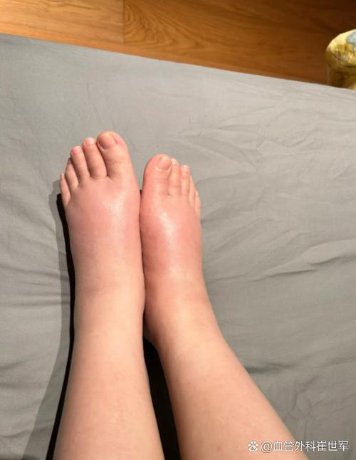 女人腿肿的6个征兆