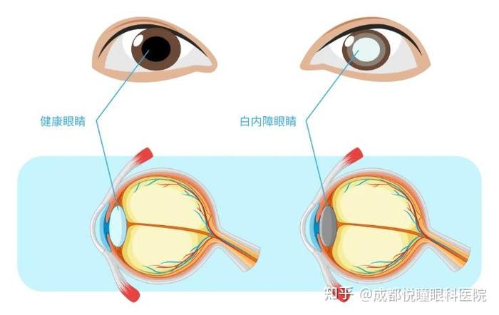 白内障的早期怎么解决