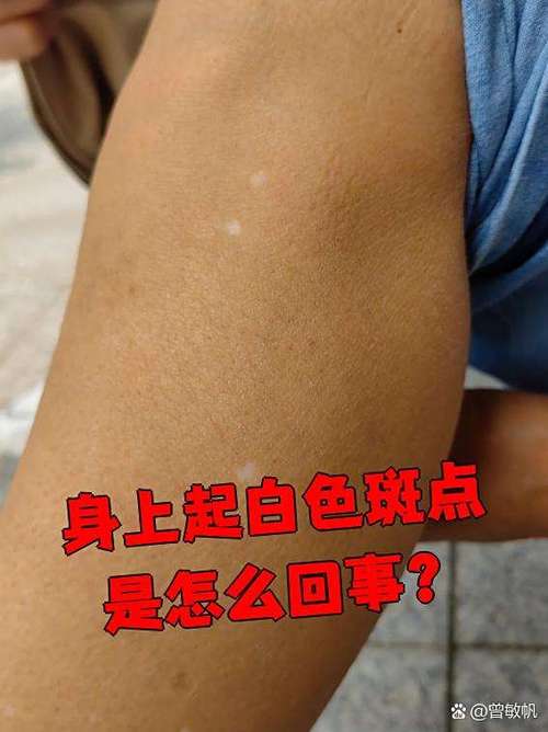 身上有白点点是什么病缩略图