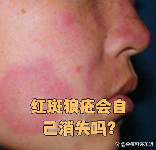 红斑狼疮会自己消退吗截图