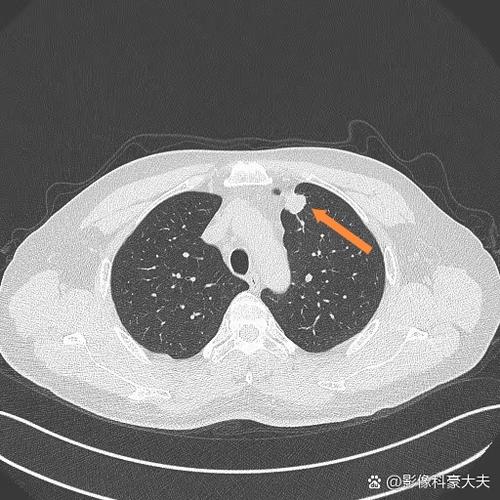 警惕转移和考虑转移区别ct结果